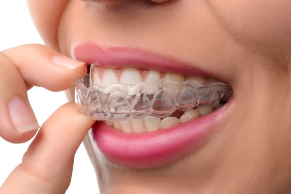 Understanding the Invisalign Doctor Site