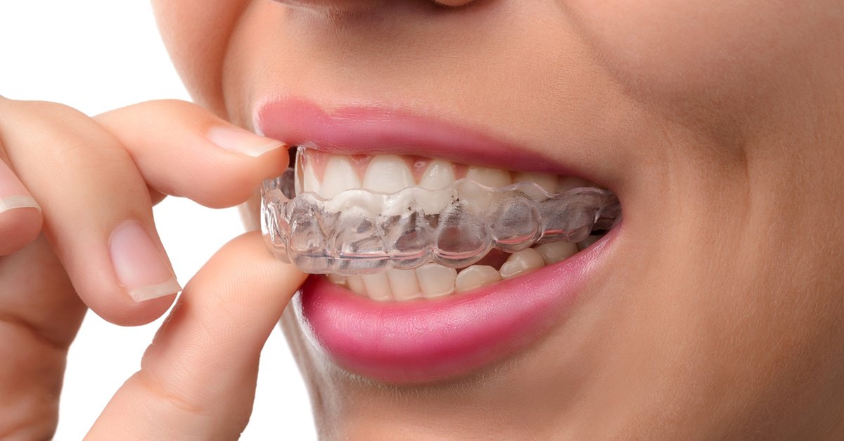 Understanding the Invisalign Doctor Site